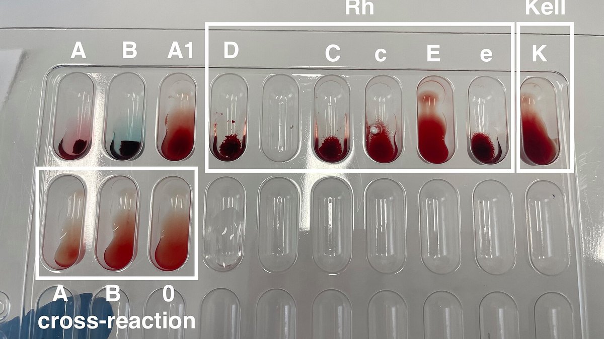 Clinical blood assay card of the kind used to measure circulating hormones such as the gonadotropins LH, FSH and hCG — Panacea Bio Chem, Bogdan Dicoias